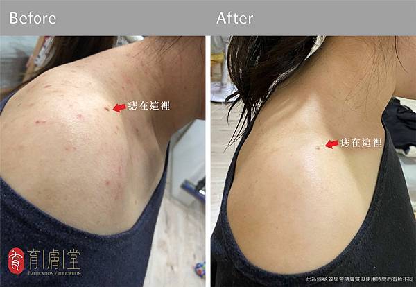 育膚堂背部痘痘使用前後.jpg 育膚堂背部痘痘使用前後.jpg