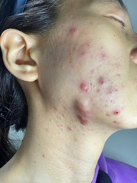 <健康-子宮內膜異位/抗痘>子宮肌腺症甘苦談-不自信的開始往 <健康-子宮內膜異位/抗痘>子宮肌腺症甘苦談-不自信的開始往