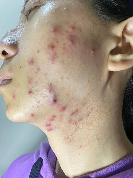 <健康-子宮內膜異位/抗痘>子宮肌腺症甘苦談-不自信的開始往 <健康-子宮內膜異位/抗痘>子宮肌腺症甘苦談-不自信的開始往