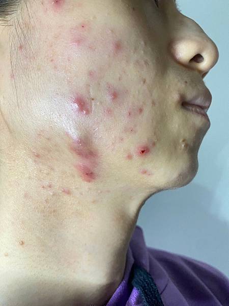 <健康-子宮內膜異位/抗痘>子宮肌腺症甘苦談-不自信的開始往 <健康-子宮內膜異位/抗痘>子宮肌腺症甘苦談-不自信的開始往