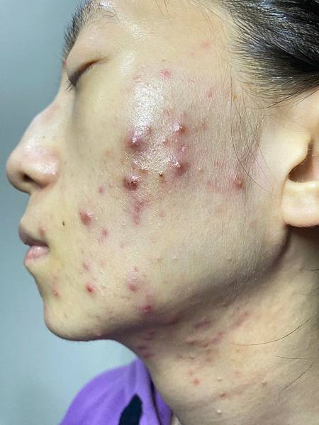 <健康-抗痘>分手計畫-與痘痘們分手技巧與心得PART.1 <健康-抗痘>分手計畫-與痘痘們分手技巧與心得PART.1