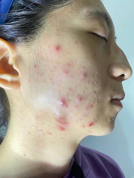 <健康-抗痘>分手計畫-與痘痘們分手技巧與心得PART.1 <健康-抗痘>分手計畫-與痘痘們分手技巧與心得PART.1