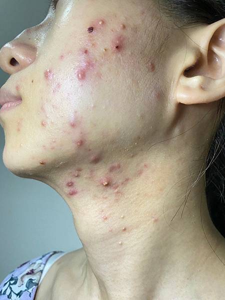 <健康-抗痘>分手計畫-與痘痘們分手技巧與心得PART.1 <健康-抗痘>分手計畫-與痘痘們分手技巧與心得PART.1