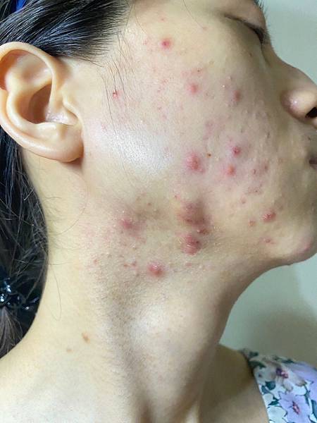 <健康-抗痘>分手計畫-與痘痘們分手技巧與心得PART.1 <健康-抗痘>分手計畫-與痘痘們分手技巧與心得PART.1