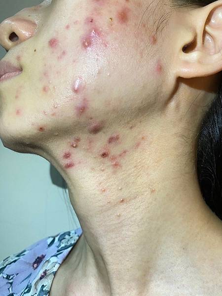 <健康-抗痘>分手計畫-與痘痘們分手技巧與心得PART.1 <健康-抗痘>分手計畫-與痘痘們分手技巧與心得PART.1