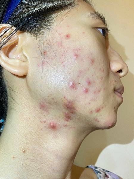 <健康-抗痘>分手計畫-與痘痘們分手技巧與心得PART.1 <健康-抗痘>分手計畫-與痘痘們分手技巧與心得PART.1