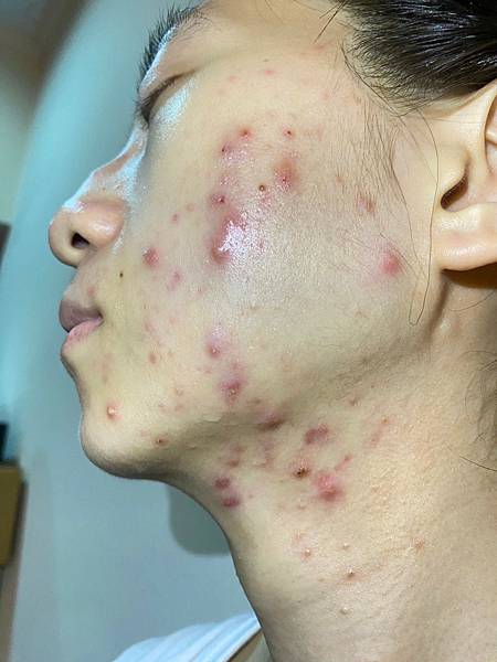 <健康-抗痘>分手計畫-與痘痘們分手技巧與心得PART.1 <健康-抗痘>分手計畫-與痘痘們分手技巧與心得PART.1