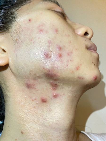 <健康-抗痘>分手計畫-與痘痘們分手技巧與心得PART.1 <健康-抗痘>分手計畫-與痘痘們分手技巧與心得PART.1