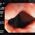 大腸鏡影像3.jpg