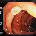 大腸鏡影像4.jpg