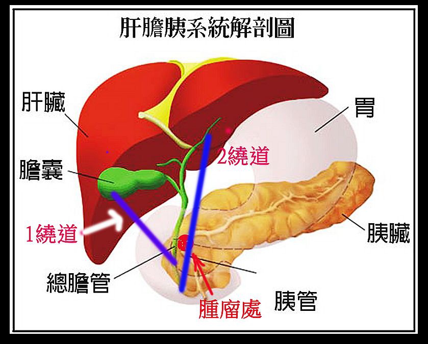 胰臟癌