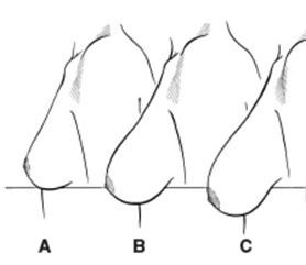 breast_ptosis_grading breast_ptosis_grading