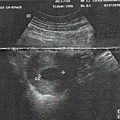 20100317-第一次產檢還是個胚胎，黑媽媽的黑球020.jpg