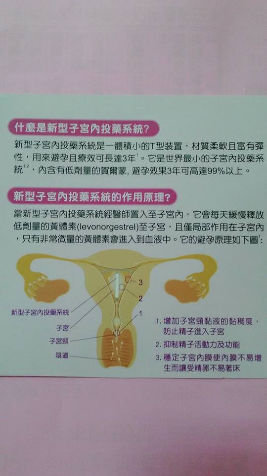 新型 子宮內投藥系統 避孕器 婦安婦產科 痞客邦
