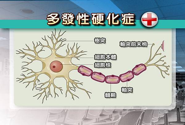 多發性硬化症症狀CG(2)