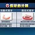 假牙的分類