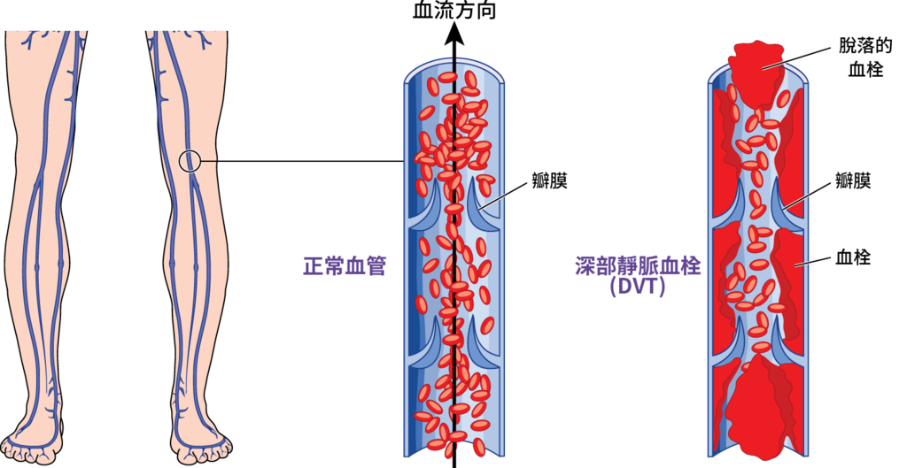 嘉義台北甘宗本醫師下肢血栓症状深部靜脈血栓治療福康診所靜脈曲張治療05.png