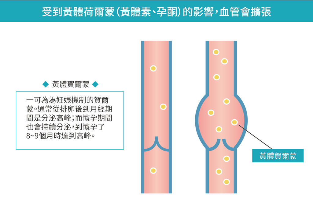 下肢靜脈曲張為何好發於女性靜脈曲張改善靜脈曲張怎麼辦002.jpg