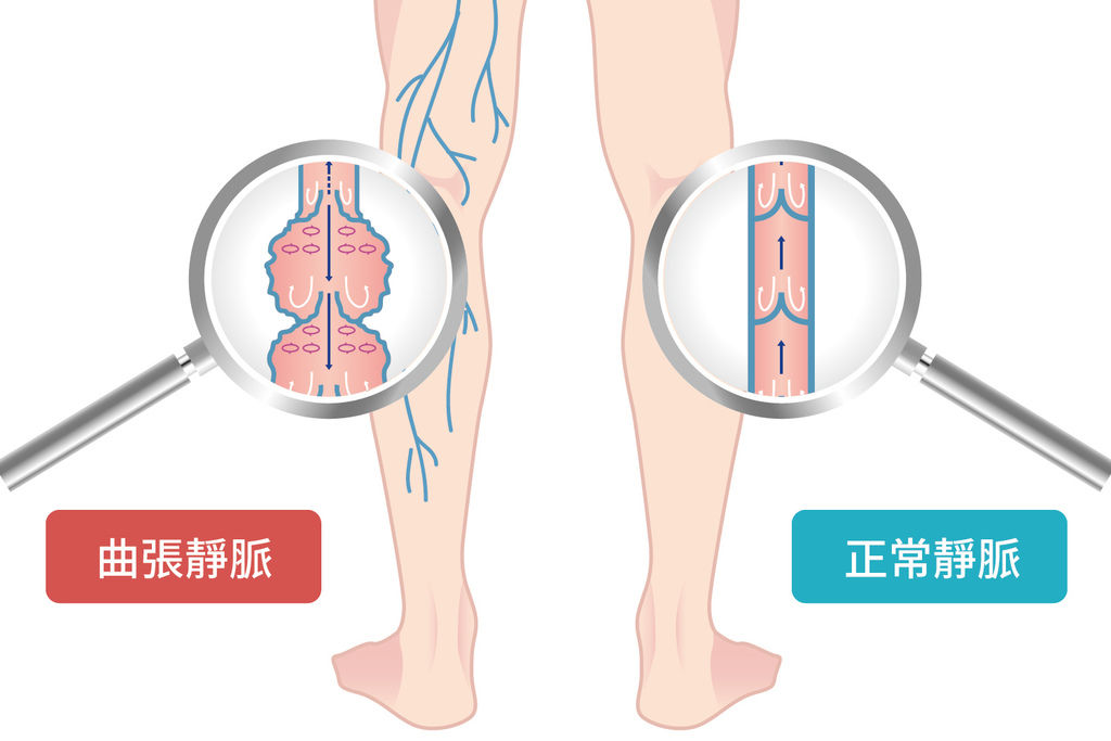 靜脈曲張治療費用靜脈曲張治療方式靜脈曲張治療推薦靜脈曲張治療高雄靜脈曲張看哪科靜脈曲張按摩02.jpg