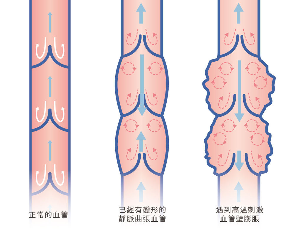 靜脈曲張手術後保養靜脈曲張治療静脉曲张治疗靜脈曲張改善靜脈曲張按摩靜脈曲張看哪科02.jpg