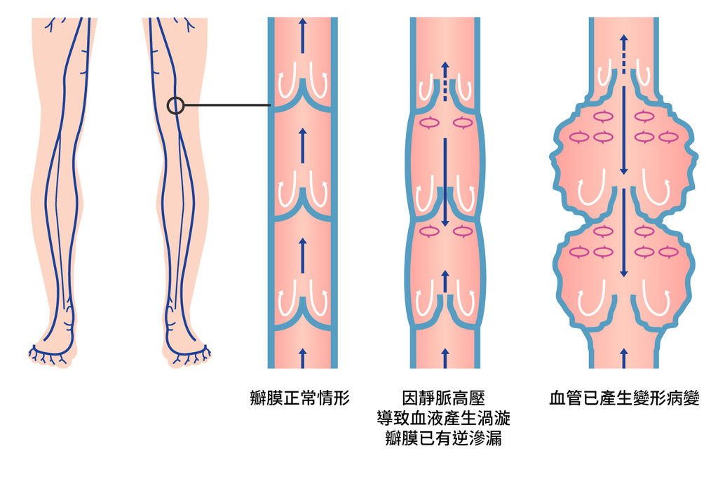 靜脈曲張成因靜脈曲張預防靜脈曲張改善靜脈曲張治療方法靜脈曲張是什麼靜脈曲張按摩靜脈曲張會怎樣預防靜脈曲張伸展操預防靜脈曲張襪02.jpg