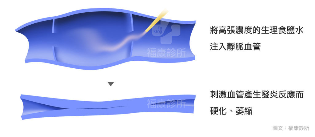 注射高張容液高濃度生理食鹽水血管硬化劑副作用靜脈曲張硬化劑副作用靜脈曲劑靜脈曲張打硬化劑好嗎靜脈曲張打針費用彈性襪好處彈性襪所台北福康診所甘宗本.jpg