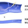 注射高張容液高濃度生理食鹽水血管硬化劑副作用靜脈曲張硬化劑副作用靜脈曲劑靜脈曲張打硬化劑好嗎靜脈曲張打針費用彈性襪好處彈性襪所台北福康診所甘宗本.jpg