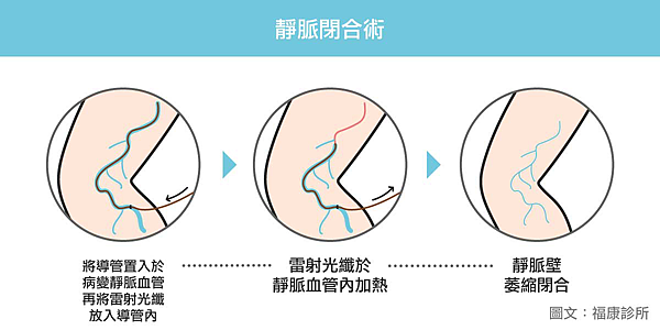 靜脈曲張推薦靜脈曲張靜脈曲張推薦台北靜脈曲張專科台北台北靜脈曲張治療靜脈曲張治療推薦靜脈曲張醫生推薦靜脈閉合術.png