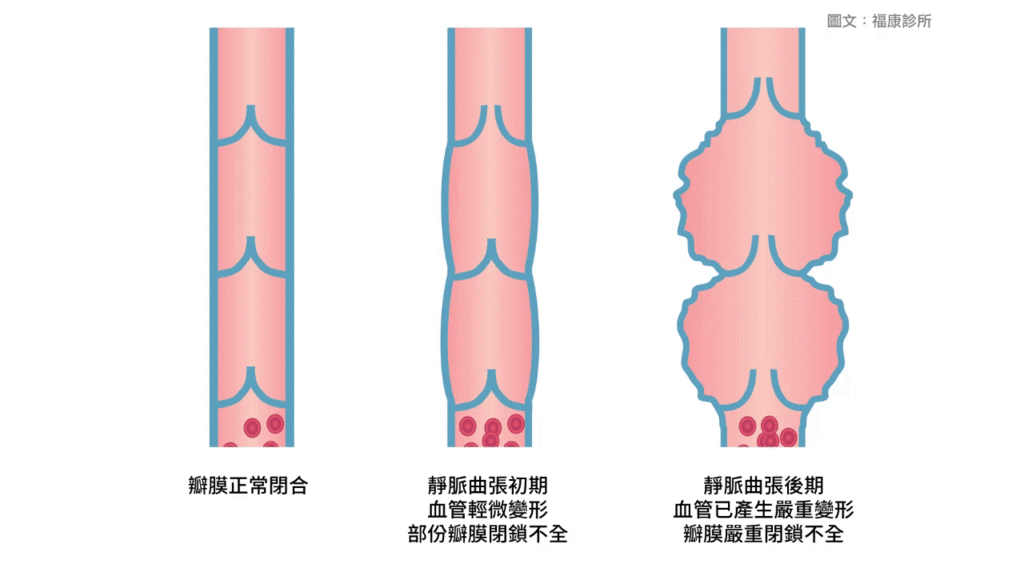 靜脈曲張專家靜脈曲張怎麼辦靜脈曲張看哪科靜脈曲張會好嗎靜脈曲張福康診所甘宗本醫師靜脈曲張專家甘宗本02.gif