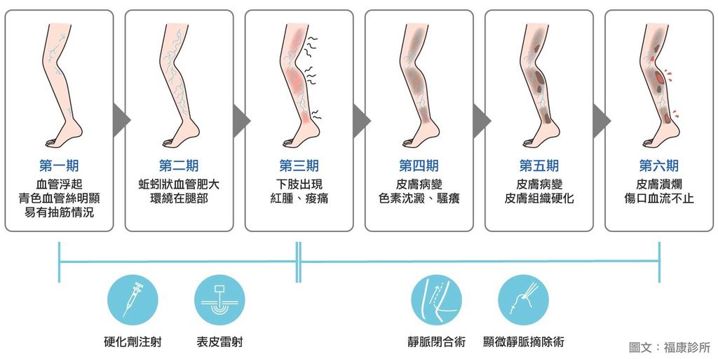 水腫靜脈曲張雷射靜脈曲張復發facebook靜脈曲張ptt靜脈曲張治療靜脈曲張手術 靜脈曲張襪靜脈曲張 診所台北靜脈曲張嘉義靜脈曲張甘宗本醫師靜脈曲張 (6).jpg