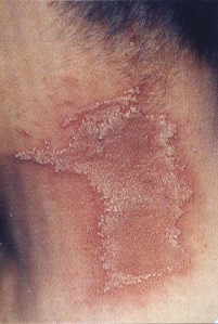 dermatitis linearis