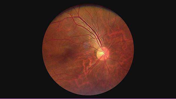 視網膜病變