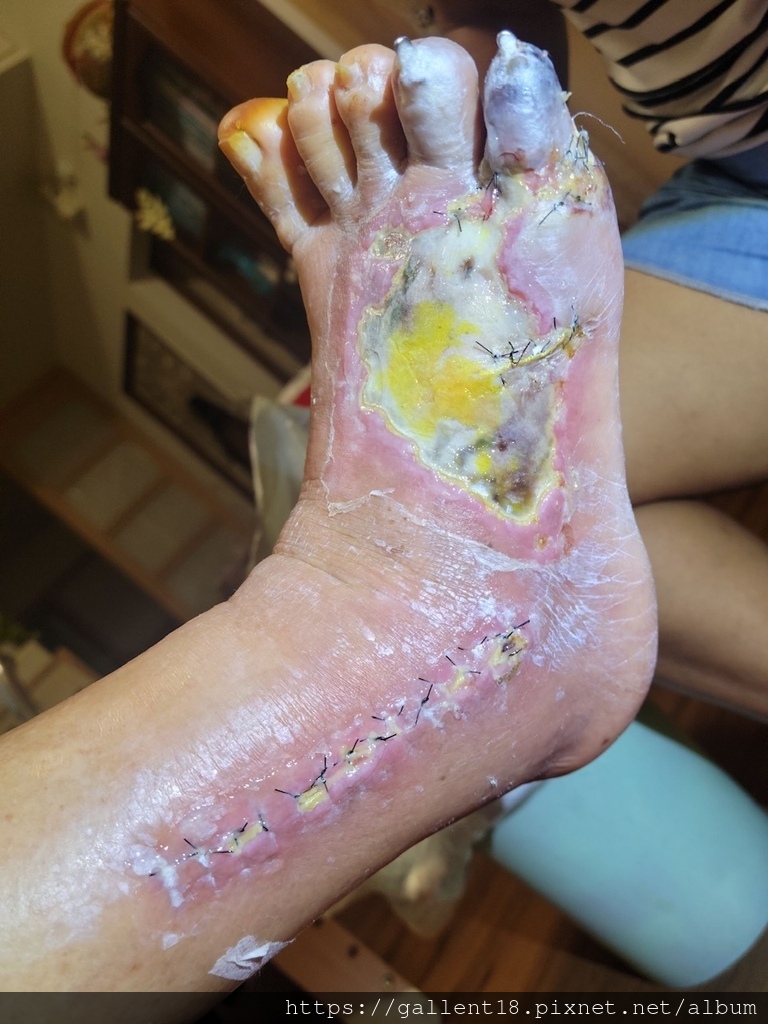 急慢性骨髓炎治驗。