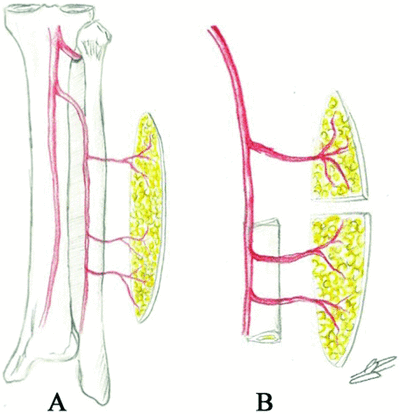 eplasty13e21_fig2