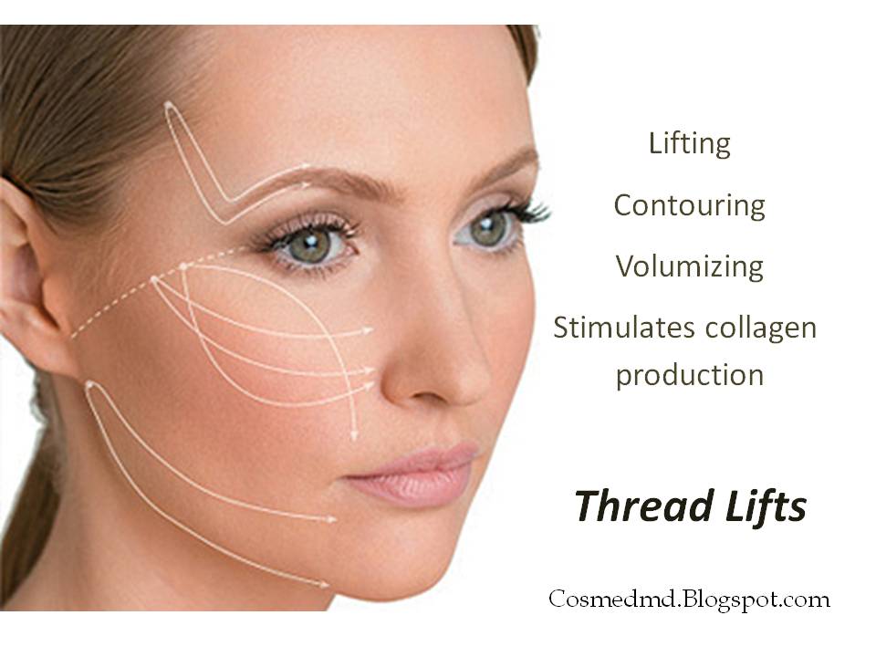 Silhouette Soft® and Silhouette Lift®（2）The 30minute procedure 察爾斯大夫