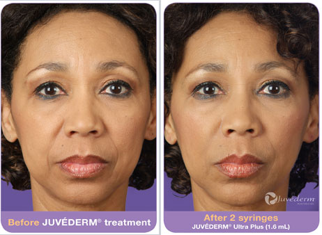 juvederm-sharon