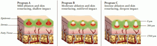 ablative-fractional-skin-treatments-ft-lauderdale-002