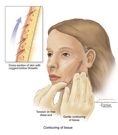 thread-lift-contouring