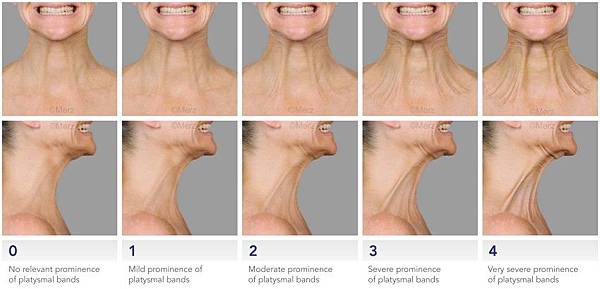 scale_platysmal_bands_Breite850