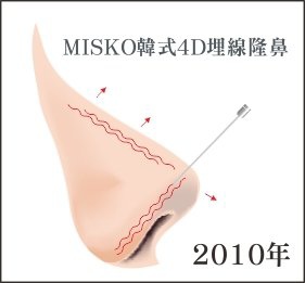 從MISKO看台灣隆鼻技術演進史