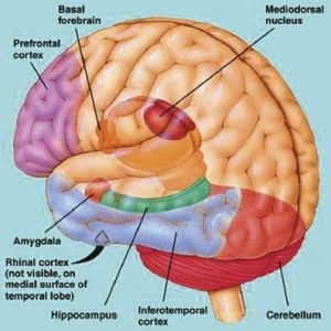 Autistic-Males-Lack-Neurons-in-the-Amygdala-2