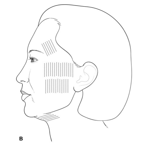 ZonesUltheraTreatment2