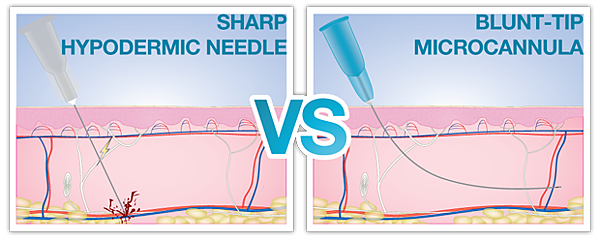 sharpvsmicrocannula_620px