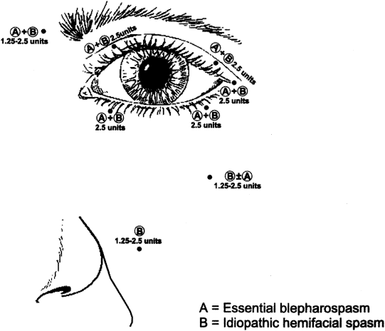 blepharospasm-botox-injection-sites-fphhiqfm