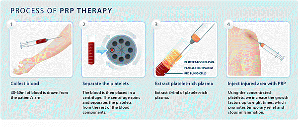 Platelet_Rich_Plasma_PRP-Therapy-IMAGE