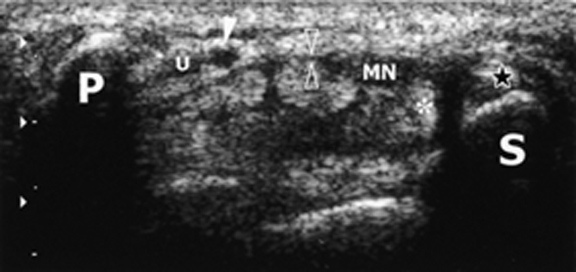 Diagnostic-Ultrasound-of-Carpal-Tunnel-emedicine