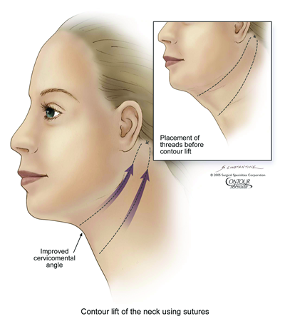 thread-lift-neck