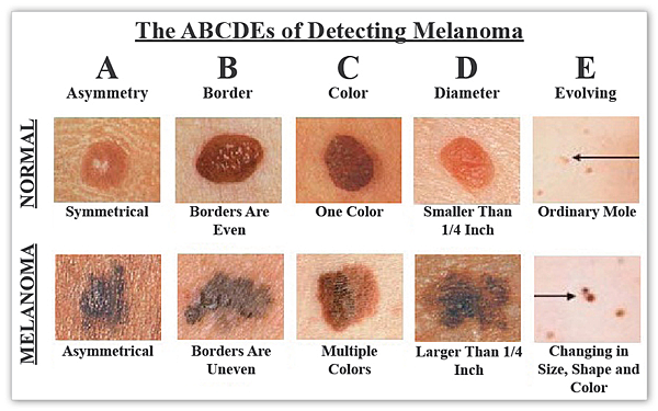 abcdes-of-melanoma-large