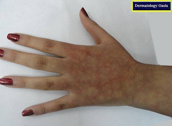 erythema-ab-igne1