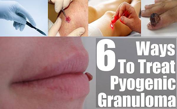 Pyogenic-Granuloma2